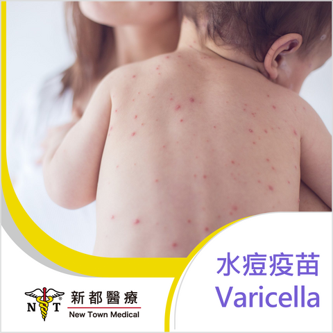 水痘疫苗 - Varicella